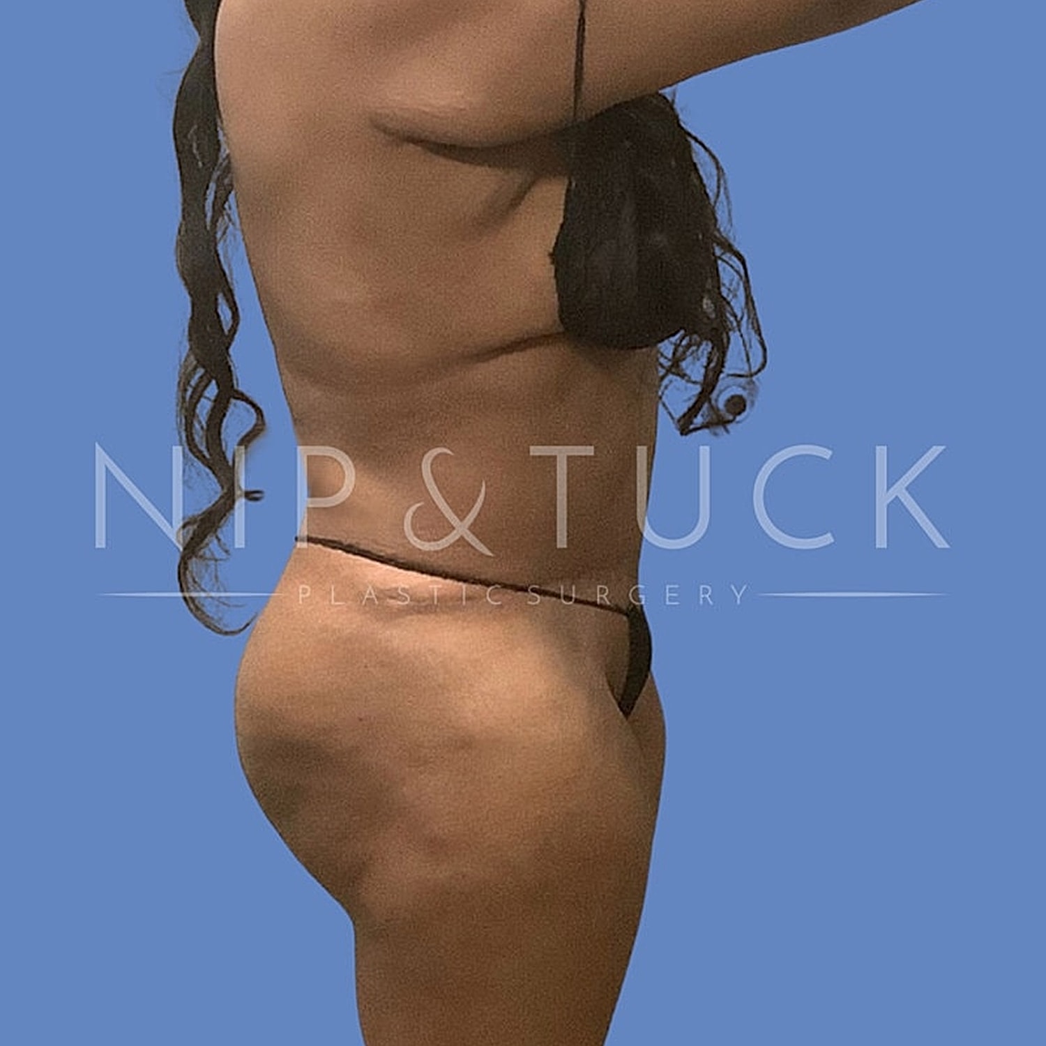 Plastic surgery before and after side profile.