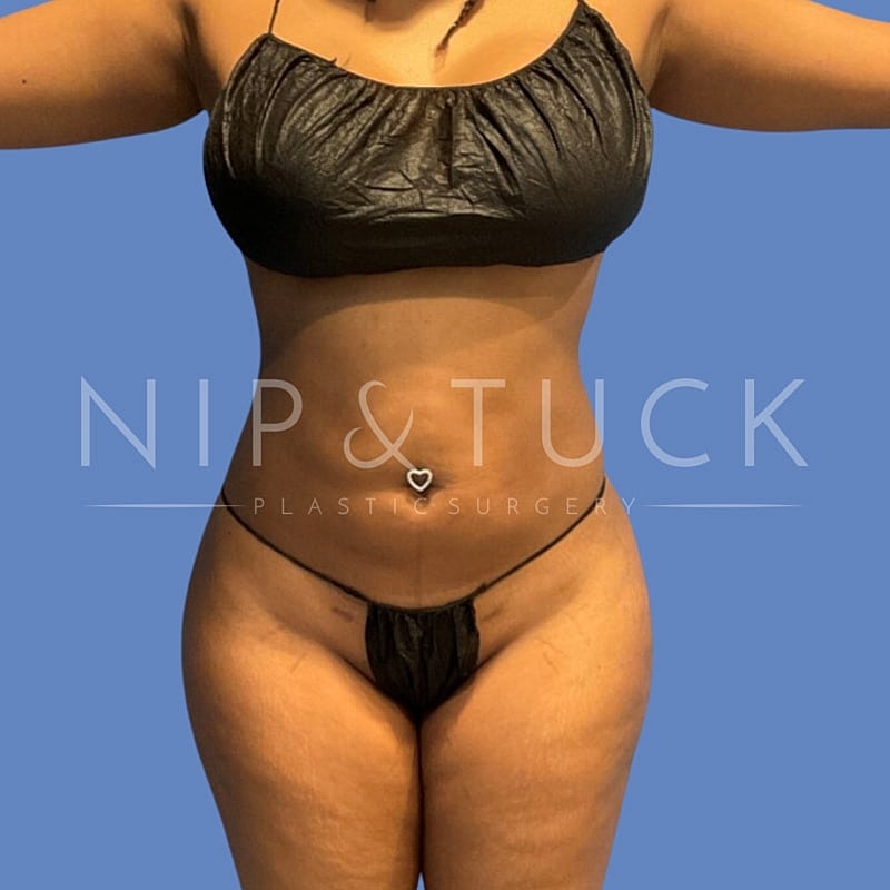 Awake Liposuction Before & After