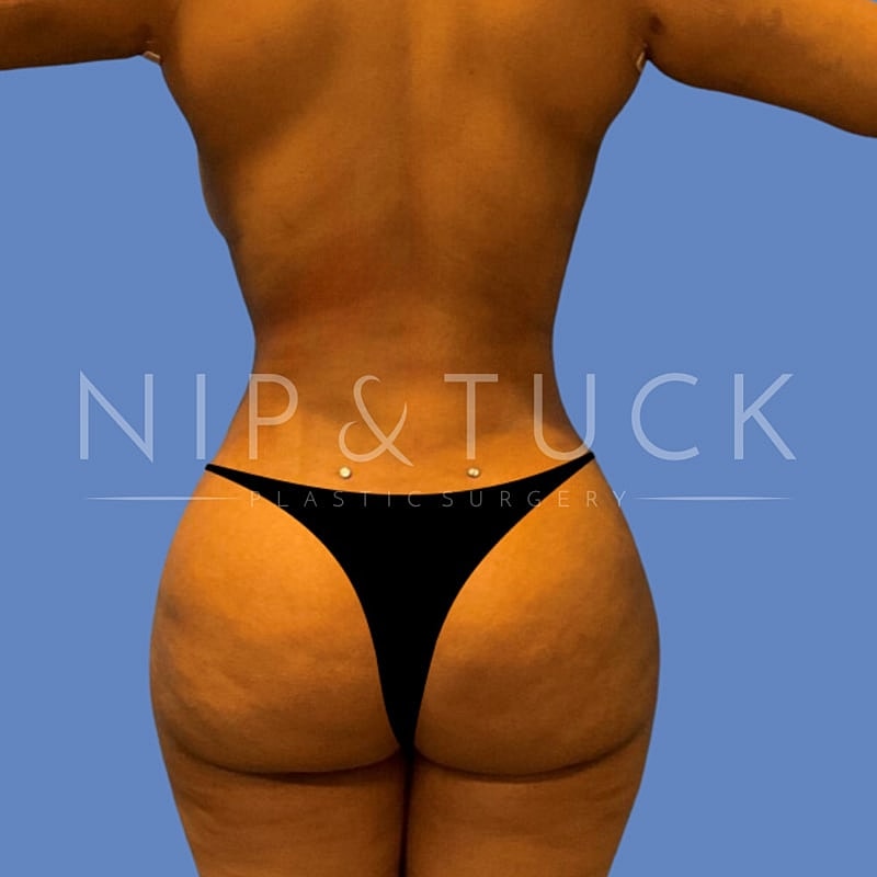 Awake Liposuction Before & After