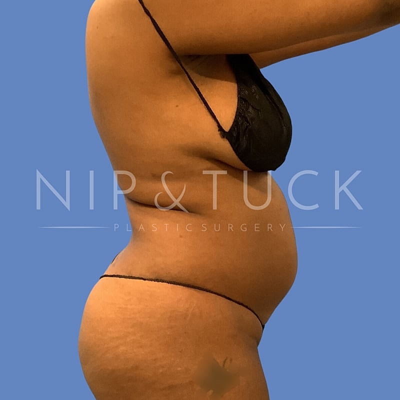 Awake Liposuction Before & After