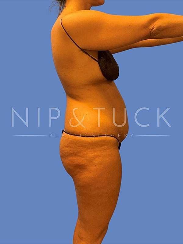 Awake Liposuction Before & After