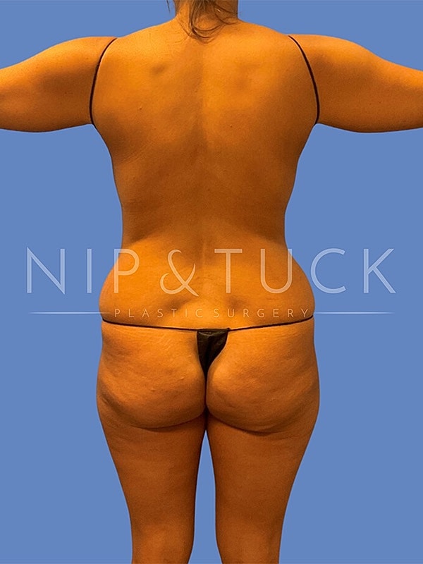 Awake Liposuction Before & After