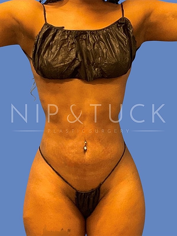 Awake Liposuction Before & After