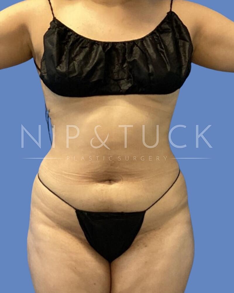 Awake Liposuction Before & After
