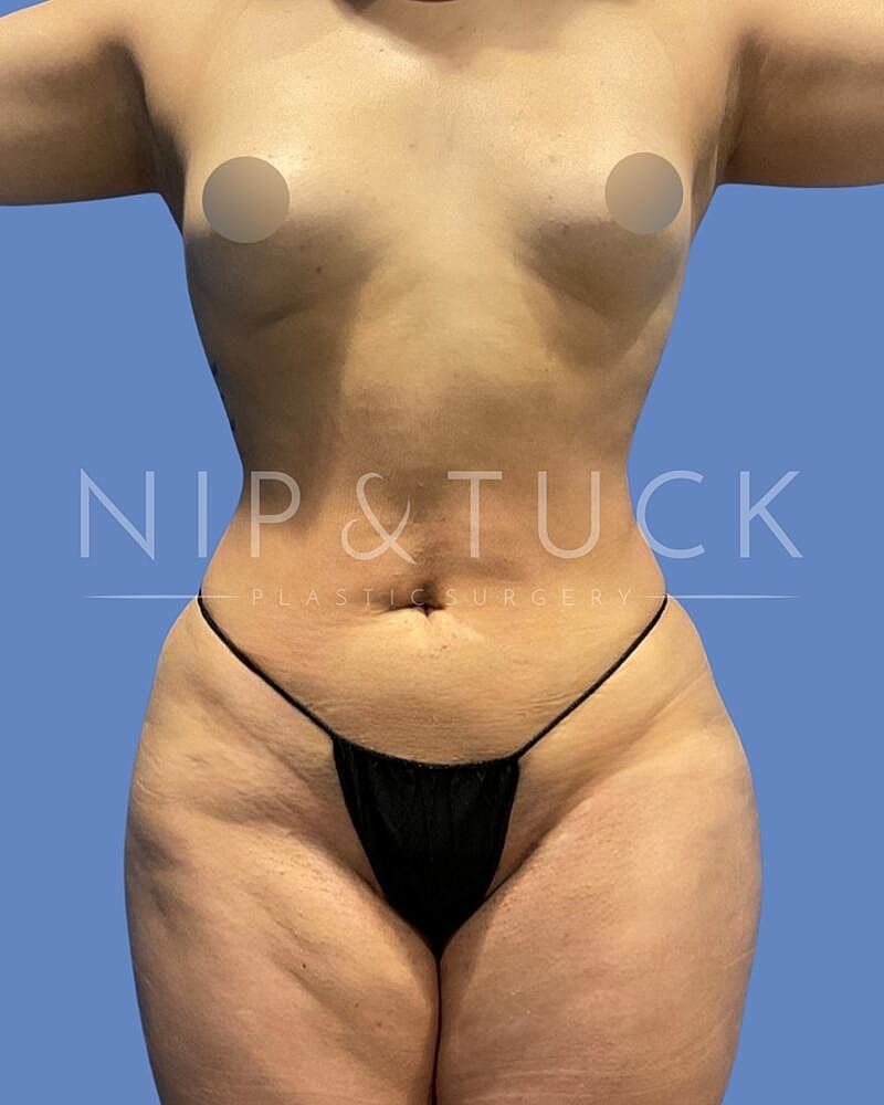 Awake Liposuction Before & After
