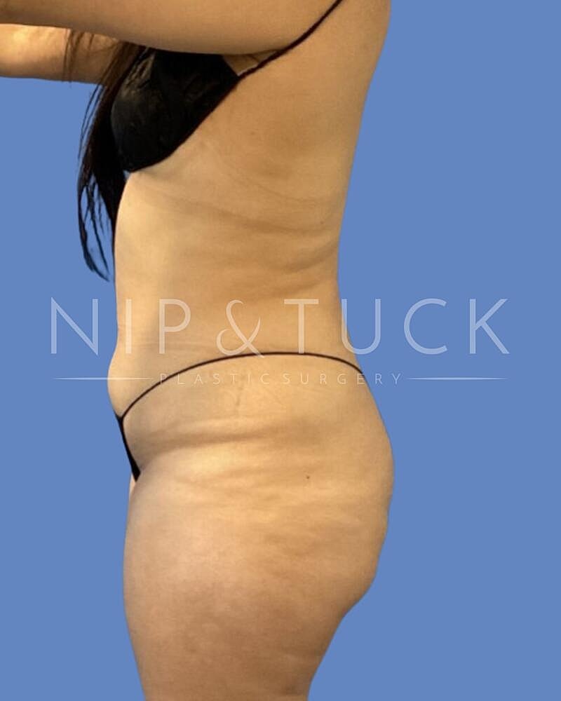 Awake Liposuction Before & After
