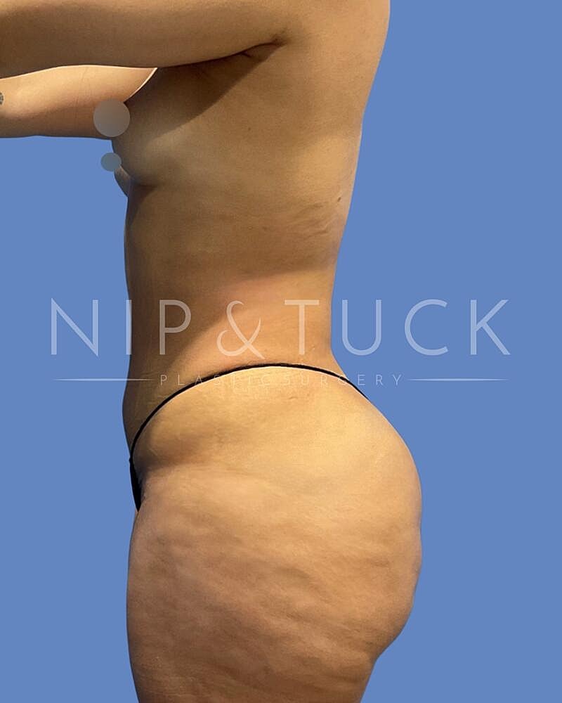 Awake Liposuction Before & After