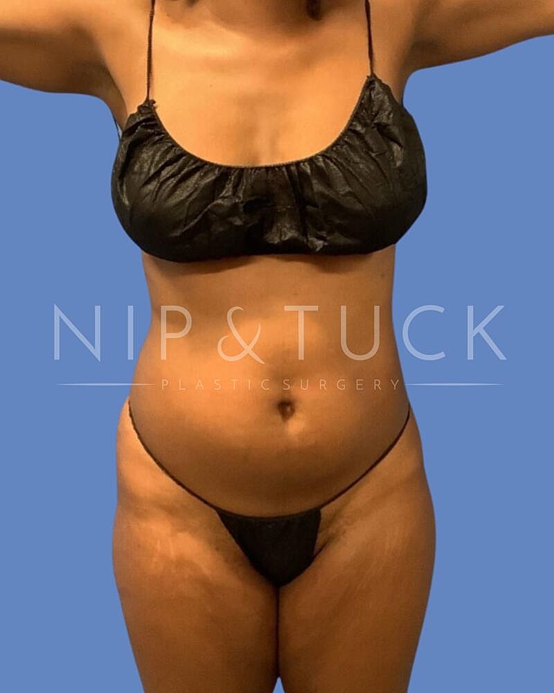 Awake Liposuction Before & After