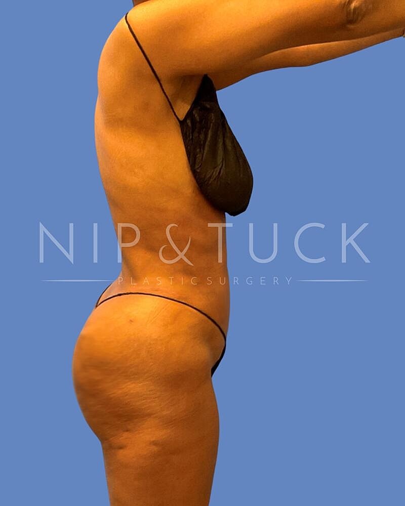 Awake Liposuction Before & After