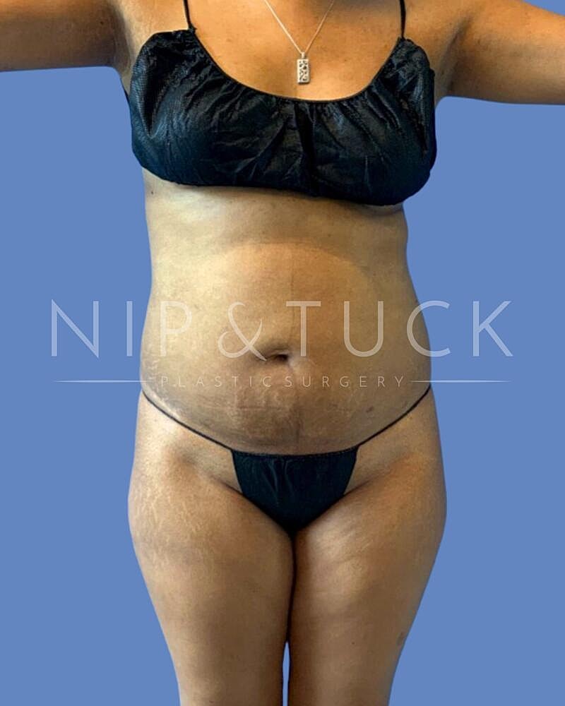 Awake Liposuction Before & After