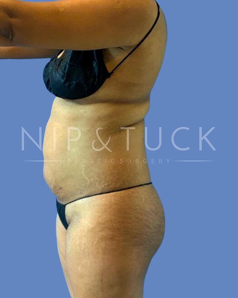 Awake Liposuction Before & After