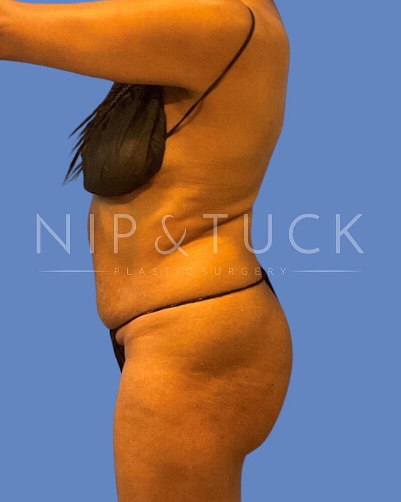 Awake Liposuction Before & After