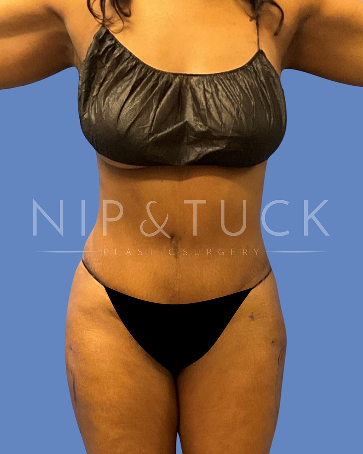 Awake Liposuction Before & After
