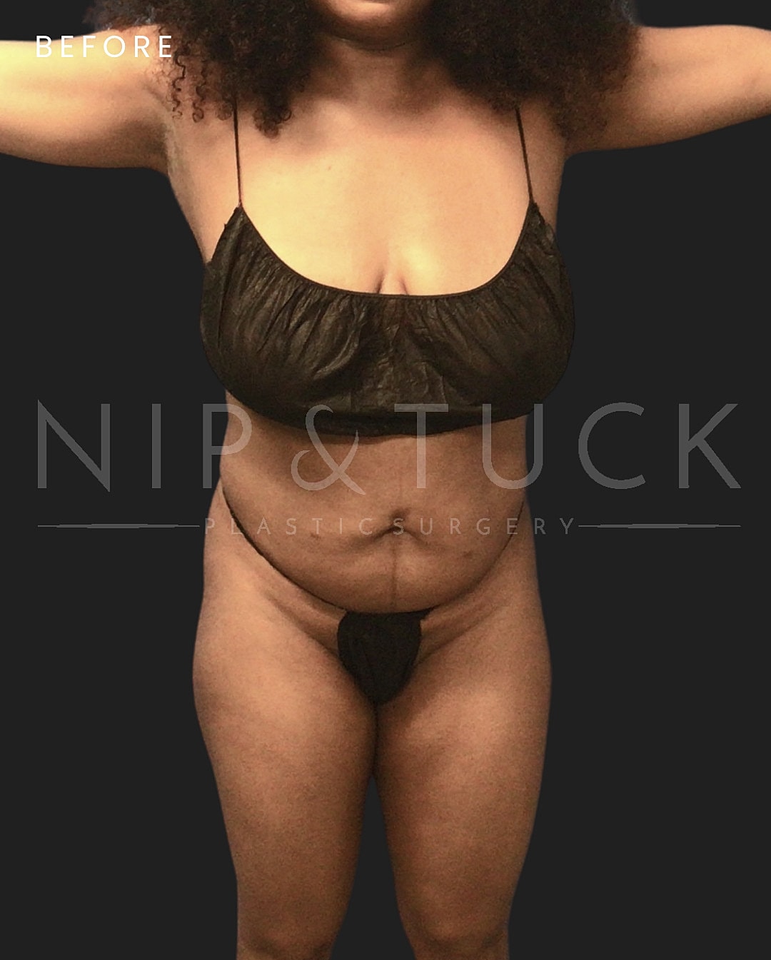 Awake Liposuction Before & After