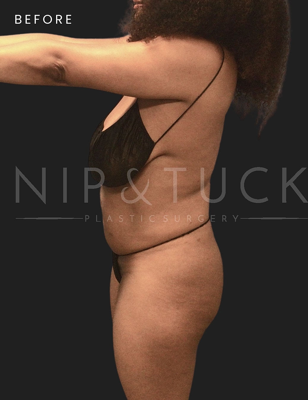 Awake Liposuction Before & After