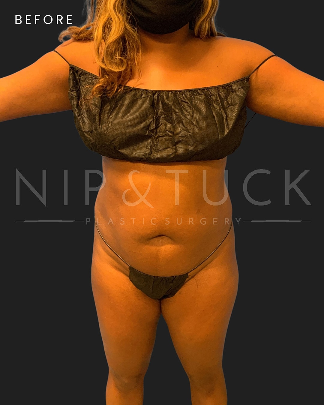 Awake Liposuction Before & After
