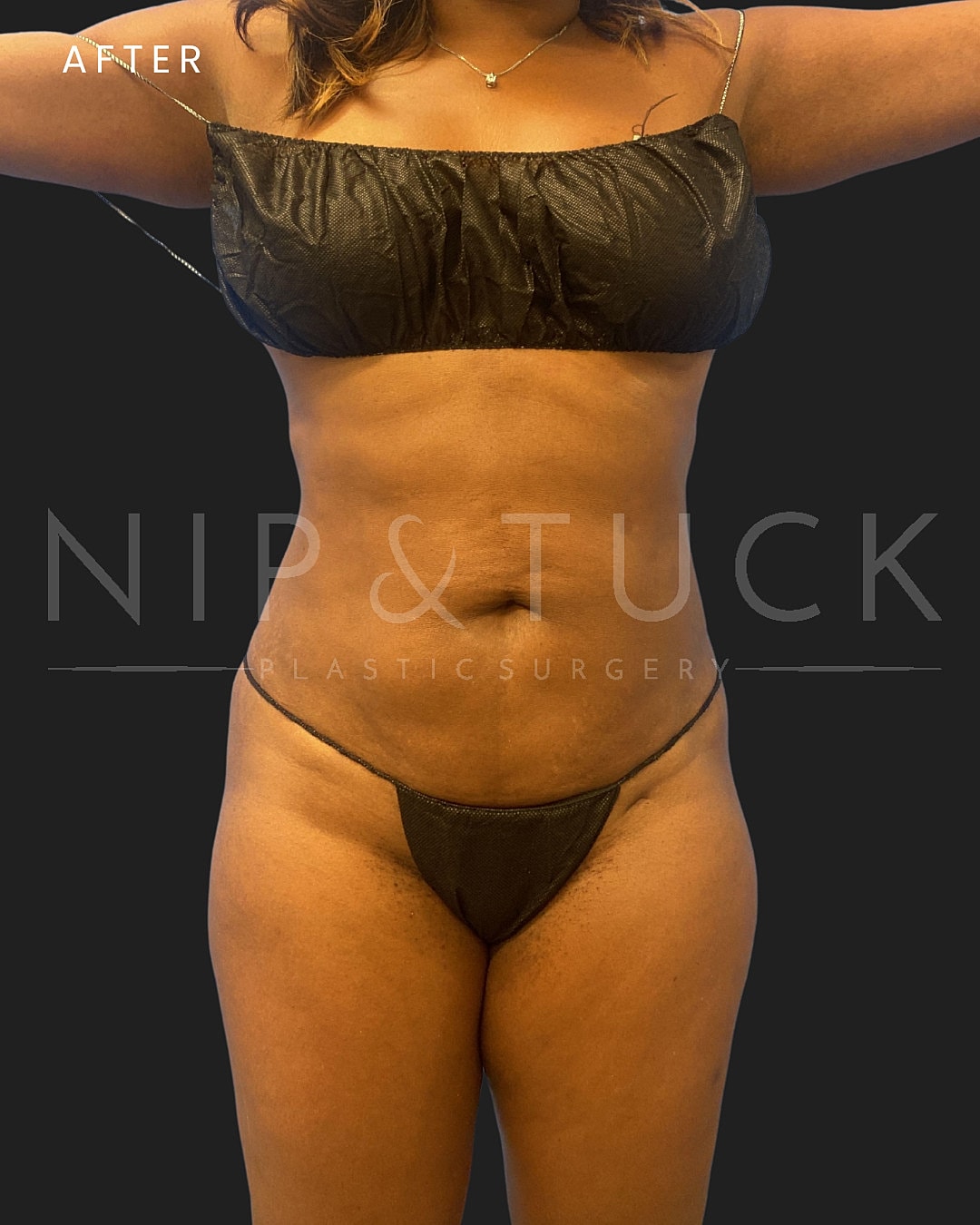 Awake Liposuction Before & After