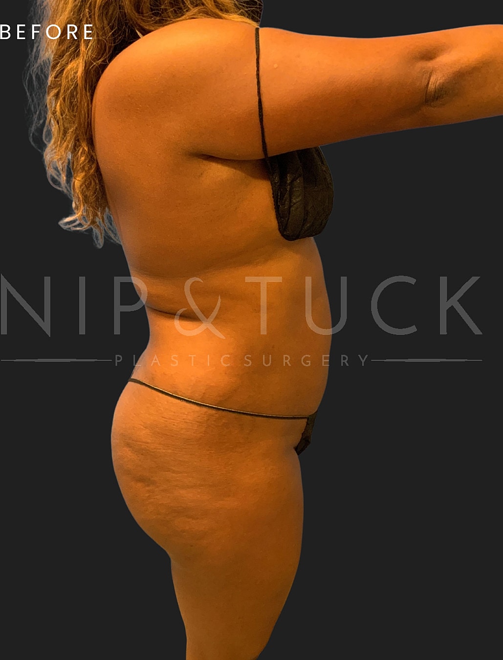 Awake Liposuction Before & After