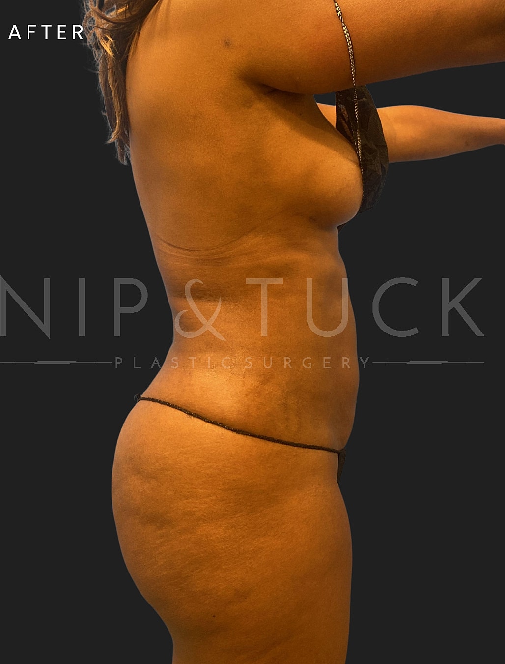 Awake Liposuction Before & After