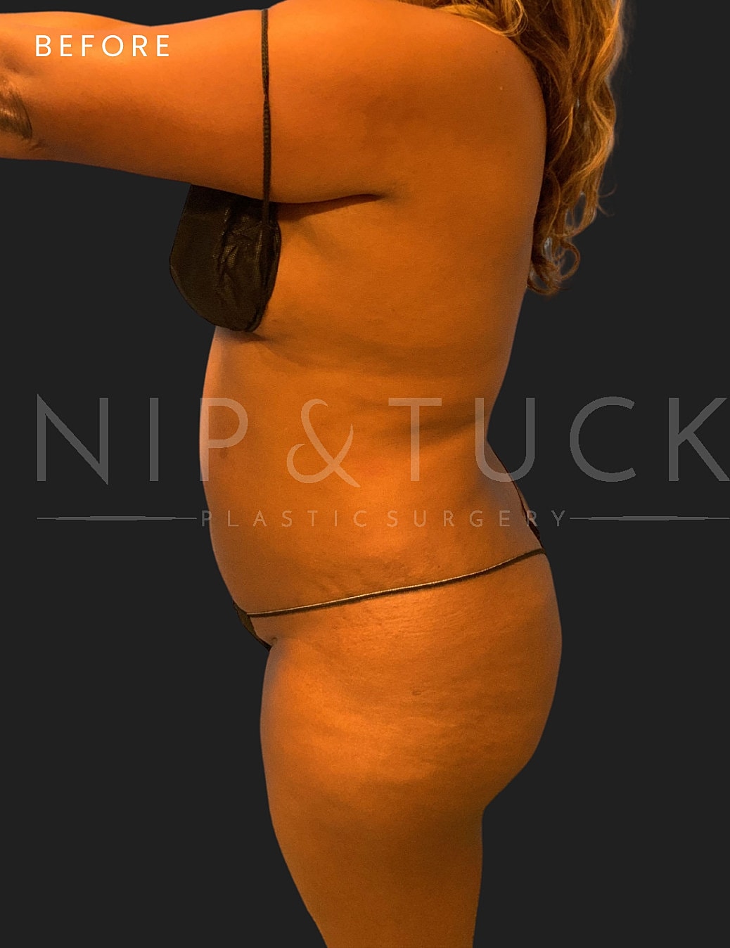 Awake Liposuction Before & After