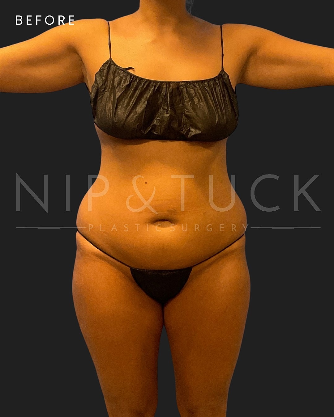 Awake Liposuction Before & After
