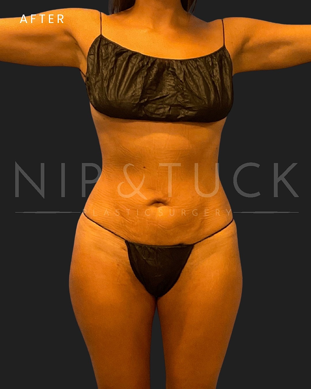 Awake Liposuction Before & After