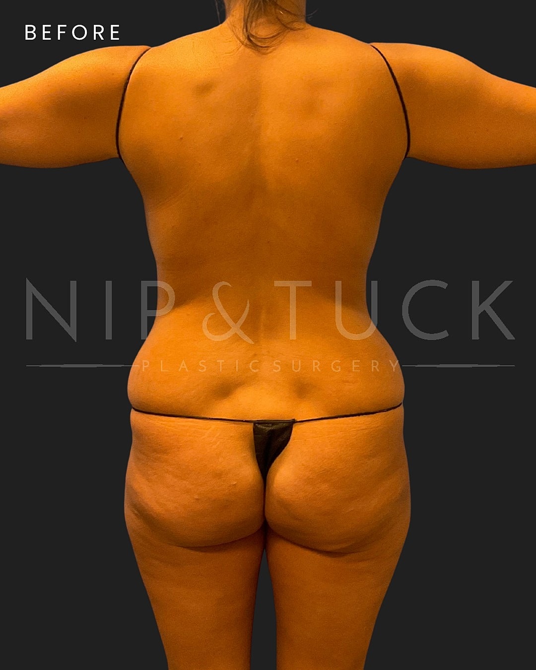 Awake Liposuction Before & After