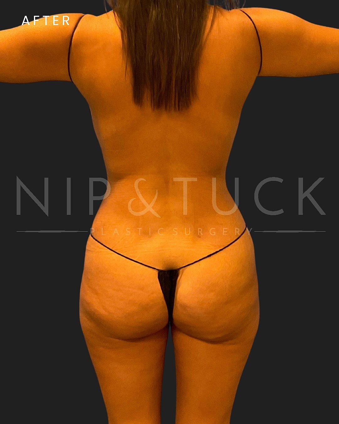 Awake Liposuction Before & After