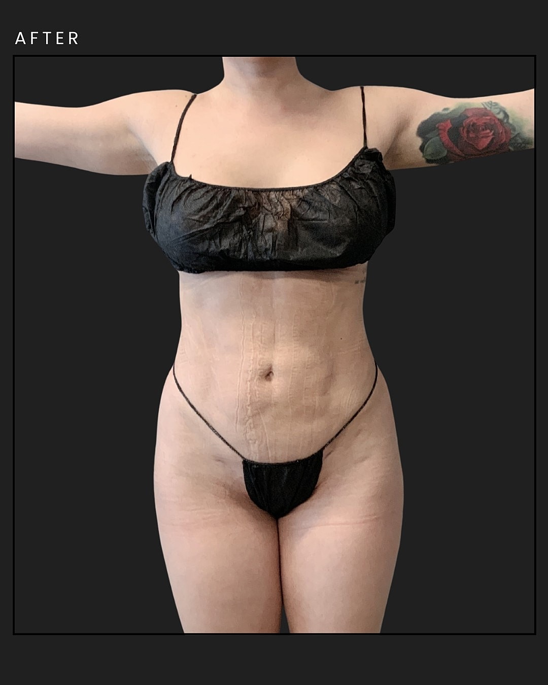 Awake Liposuction Before & After
