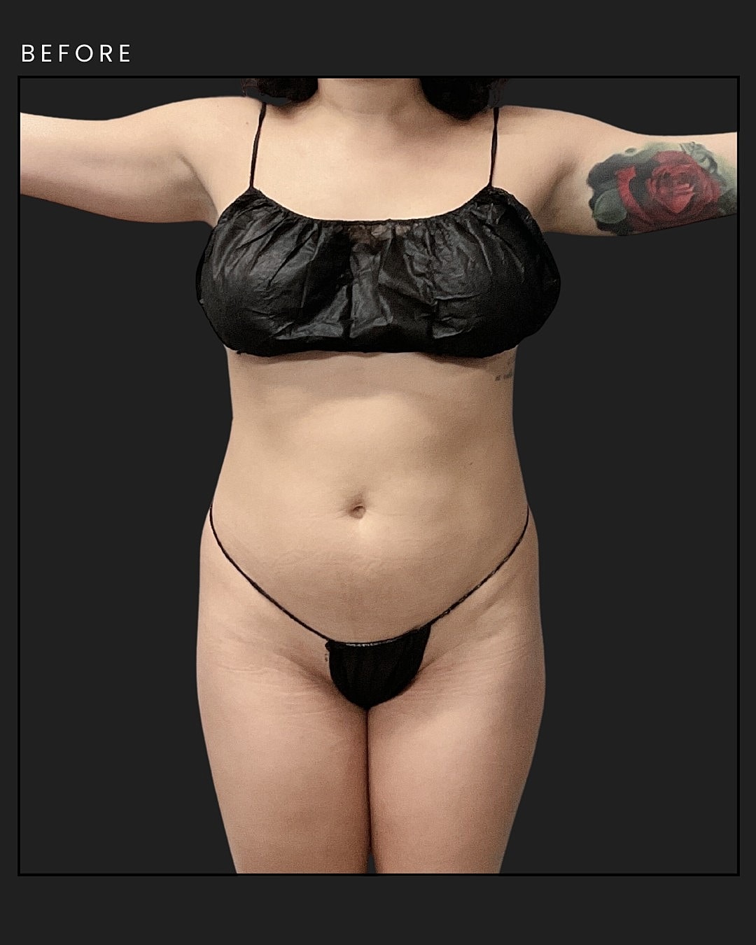 Awake Liposuction Before & After