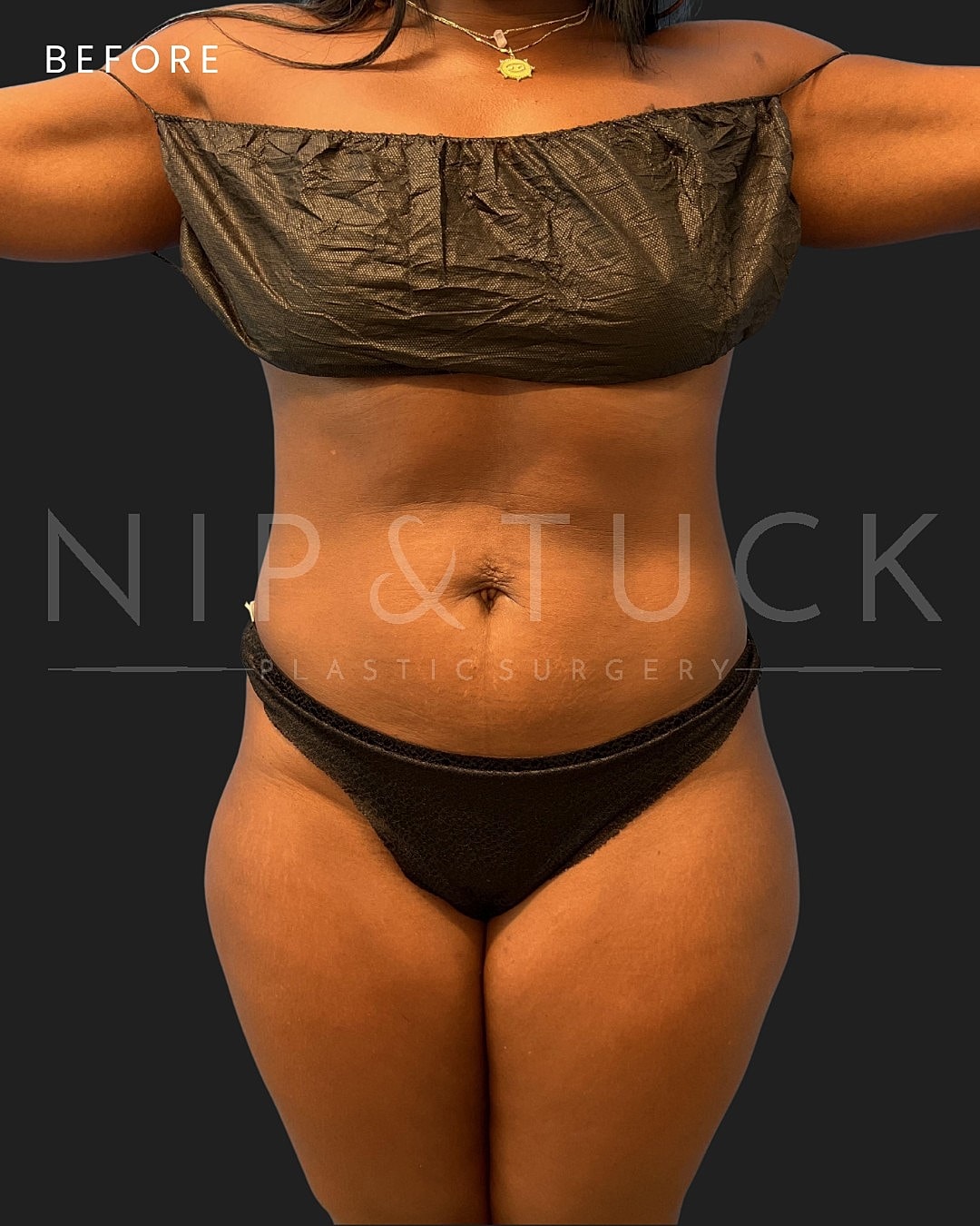 Awake Liposuction Before & After