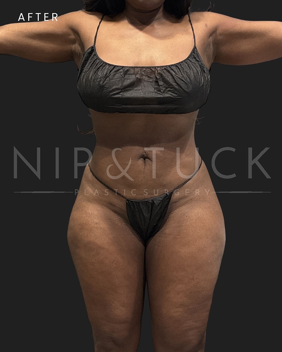 Awake Liposuction Before & After