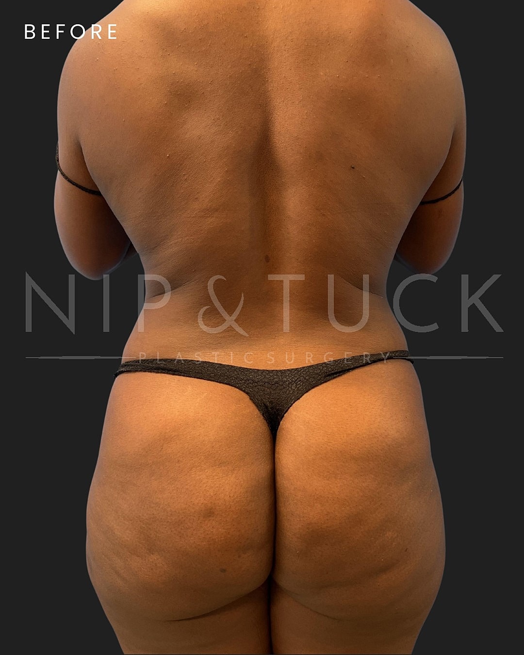 Awake Liposuction Before & After