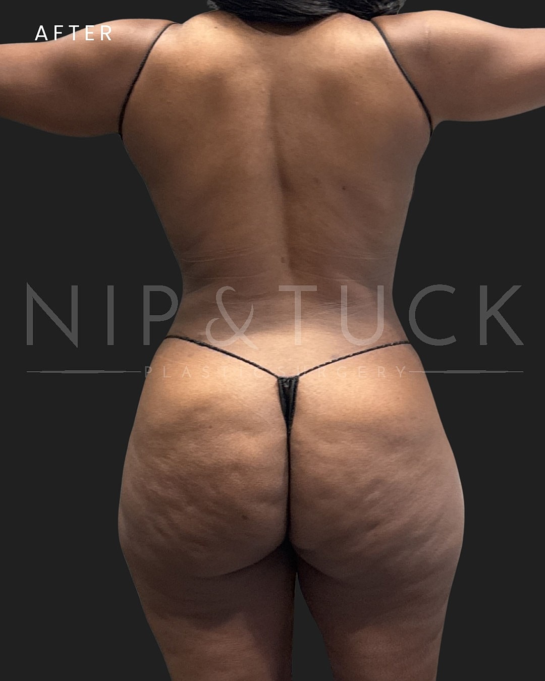 Awake Liposuction Before & After