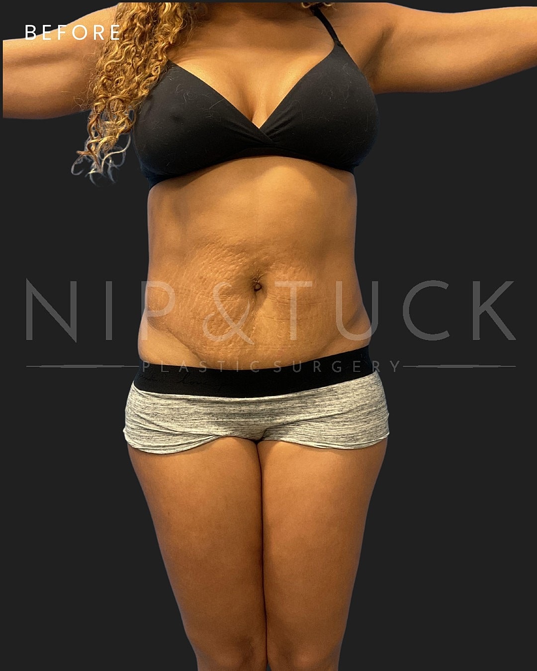 Awake Liposuction Before & After