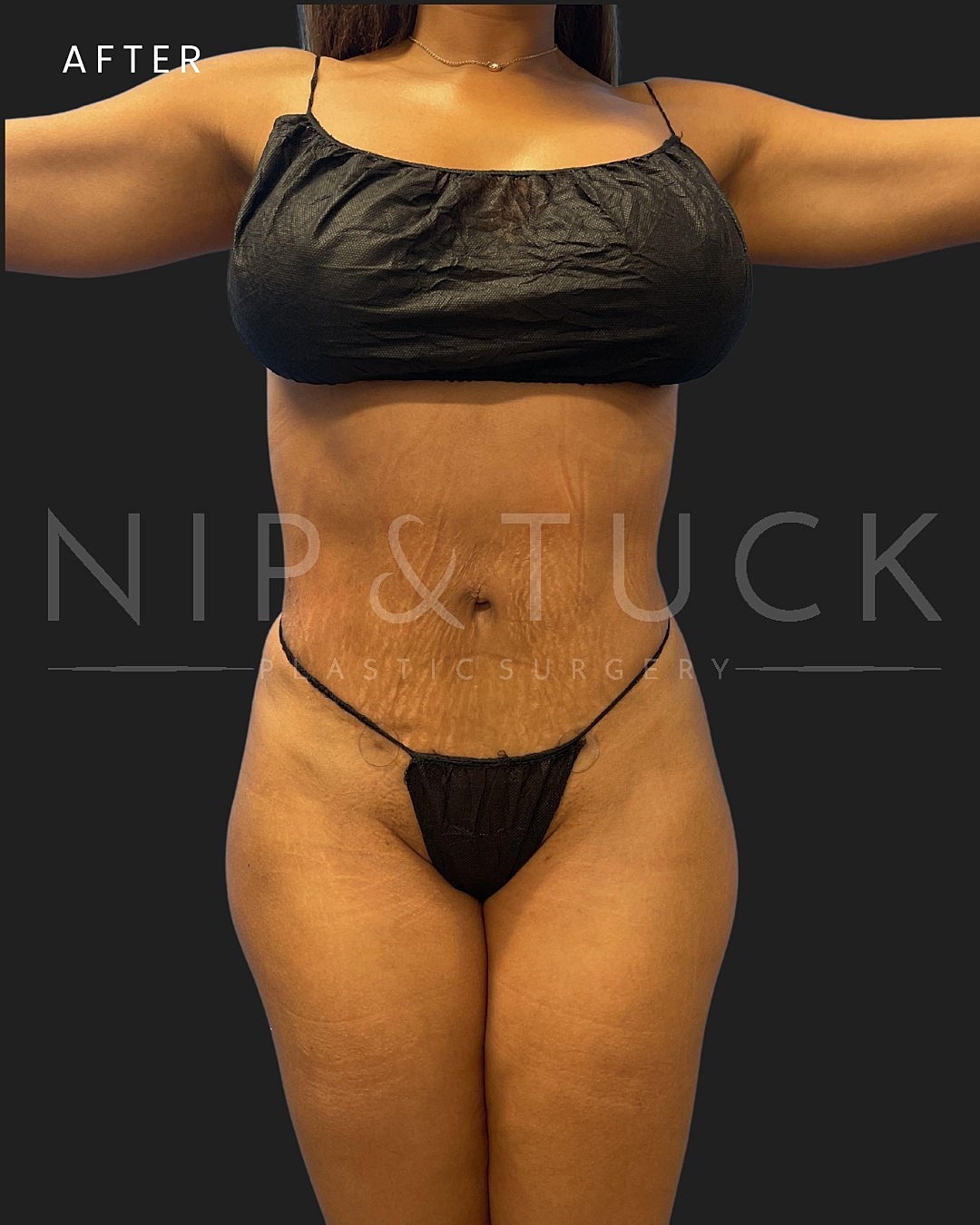 Awake Liposuction Before & After