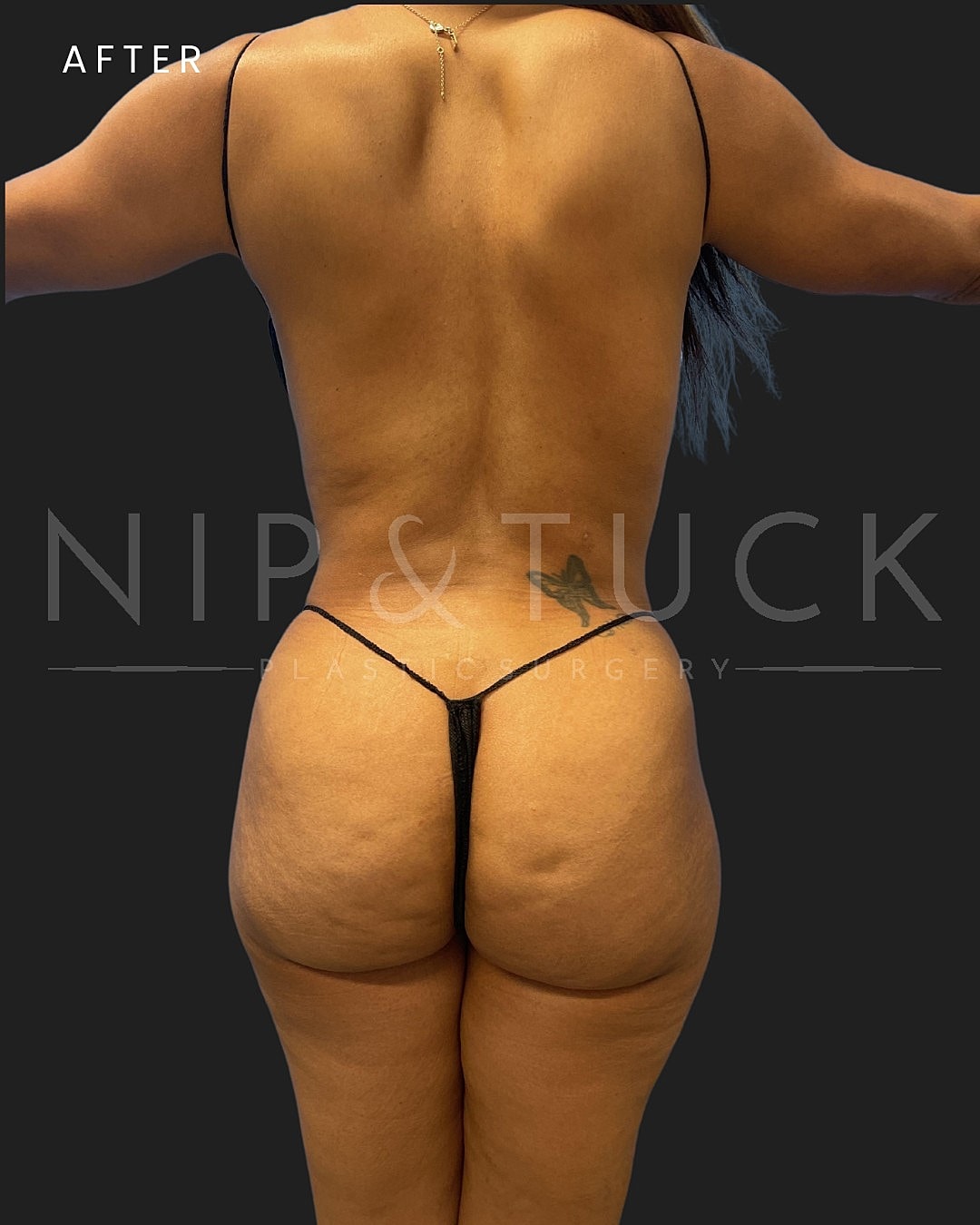 Awake Liposuction Before & After