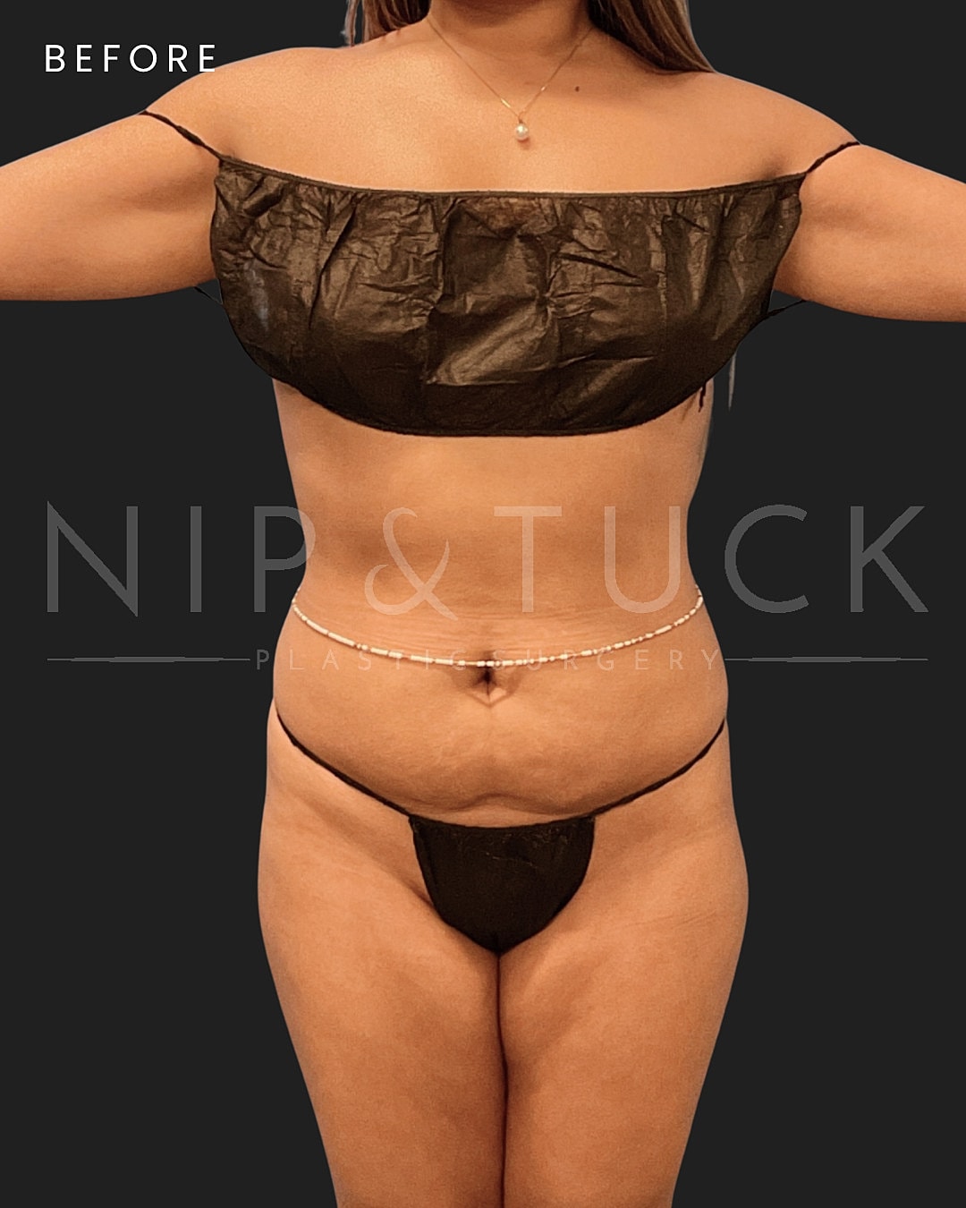 Vaser Liposuction Before & After