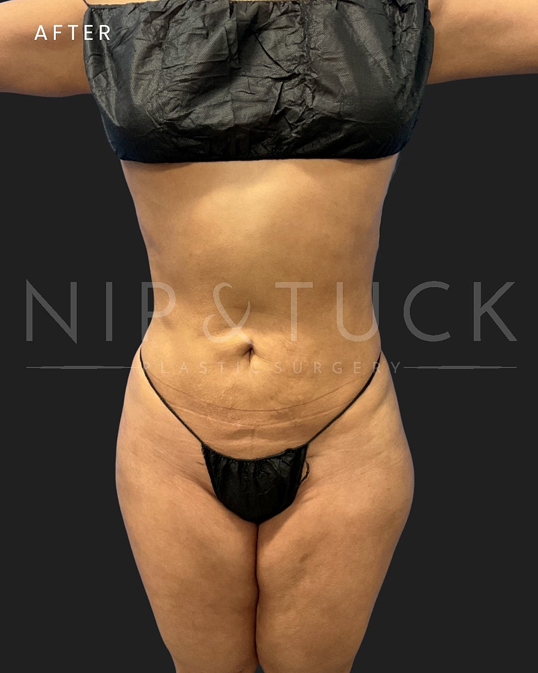 Vaser Liposuction Before & After