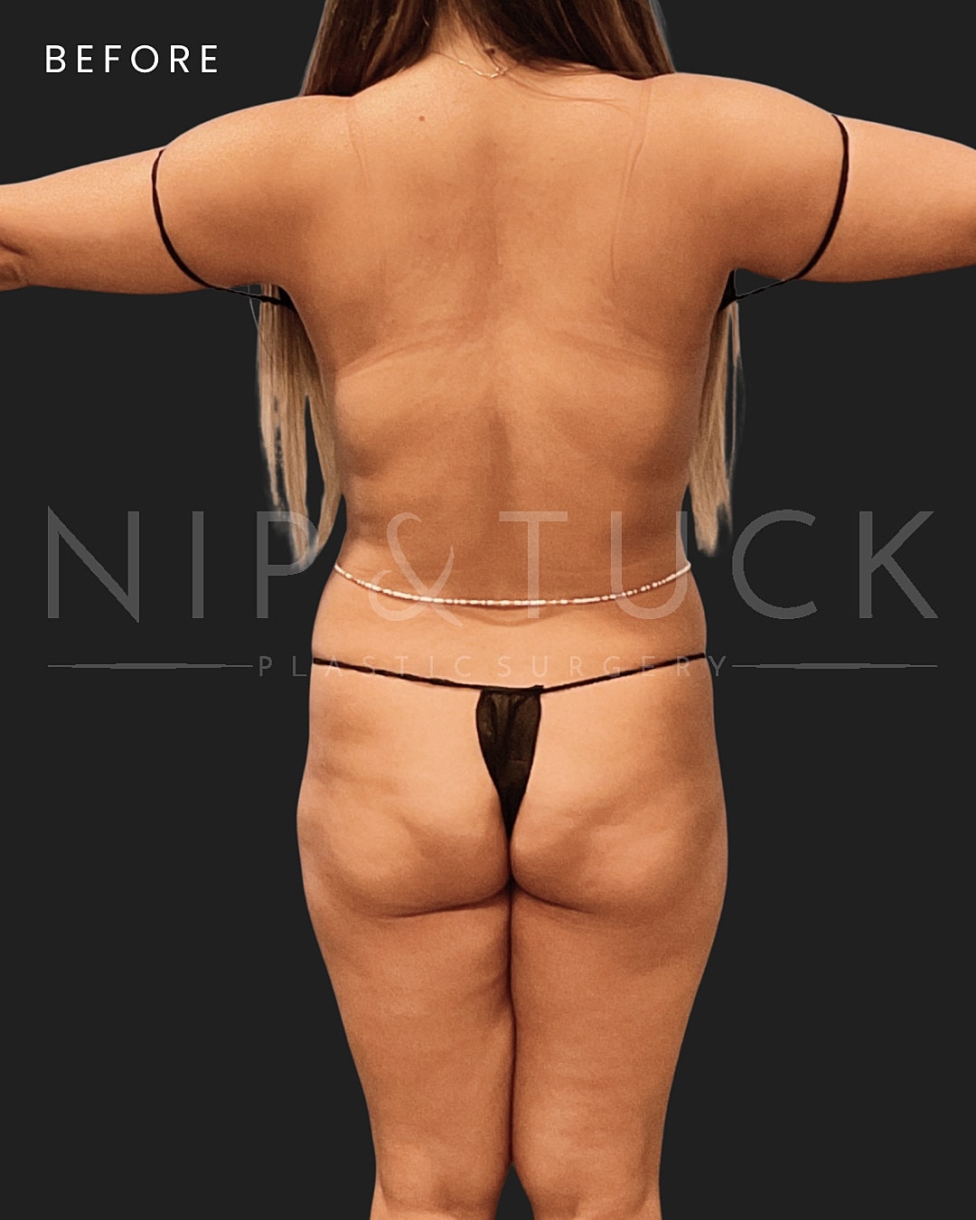 Vaser Liposuction Before & After