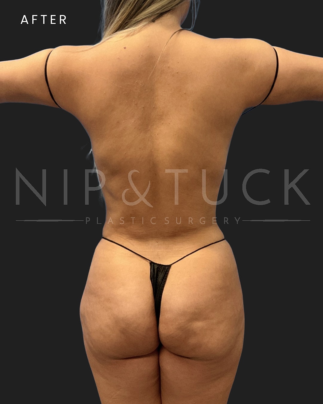 Vaser Liposuction Before & After