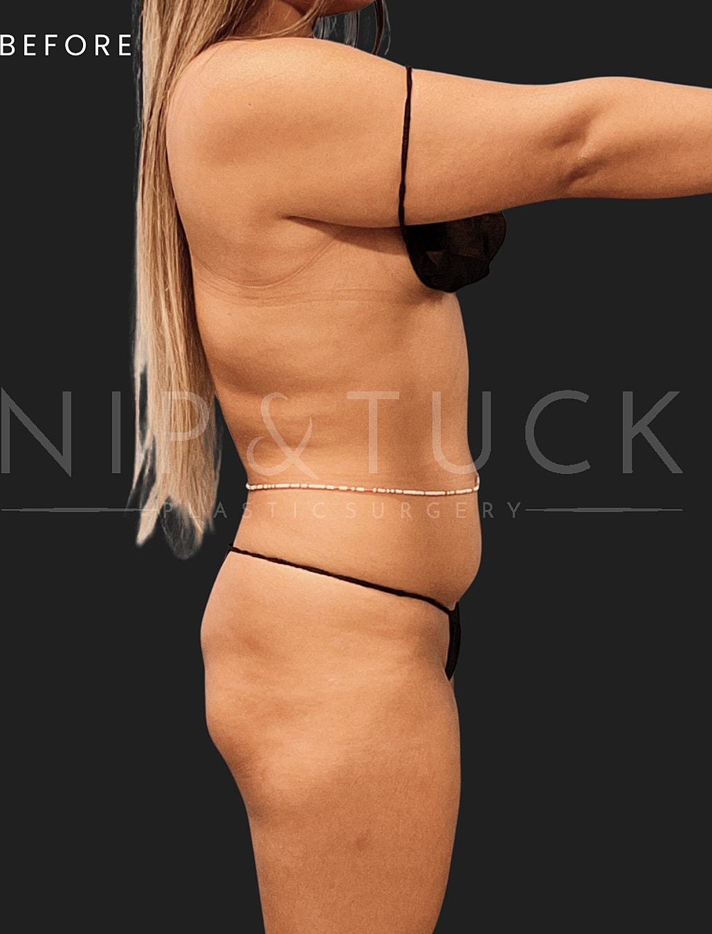 Vaser Liposuction Before & After