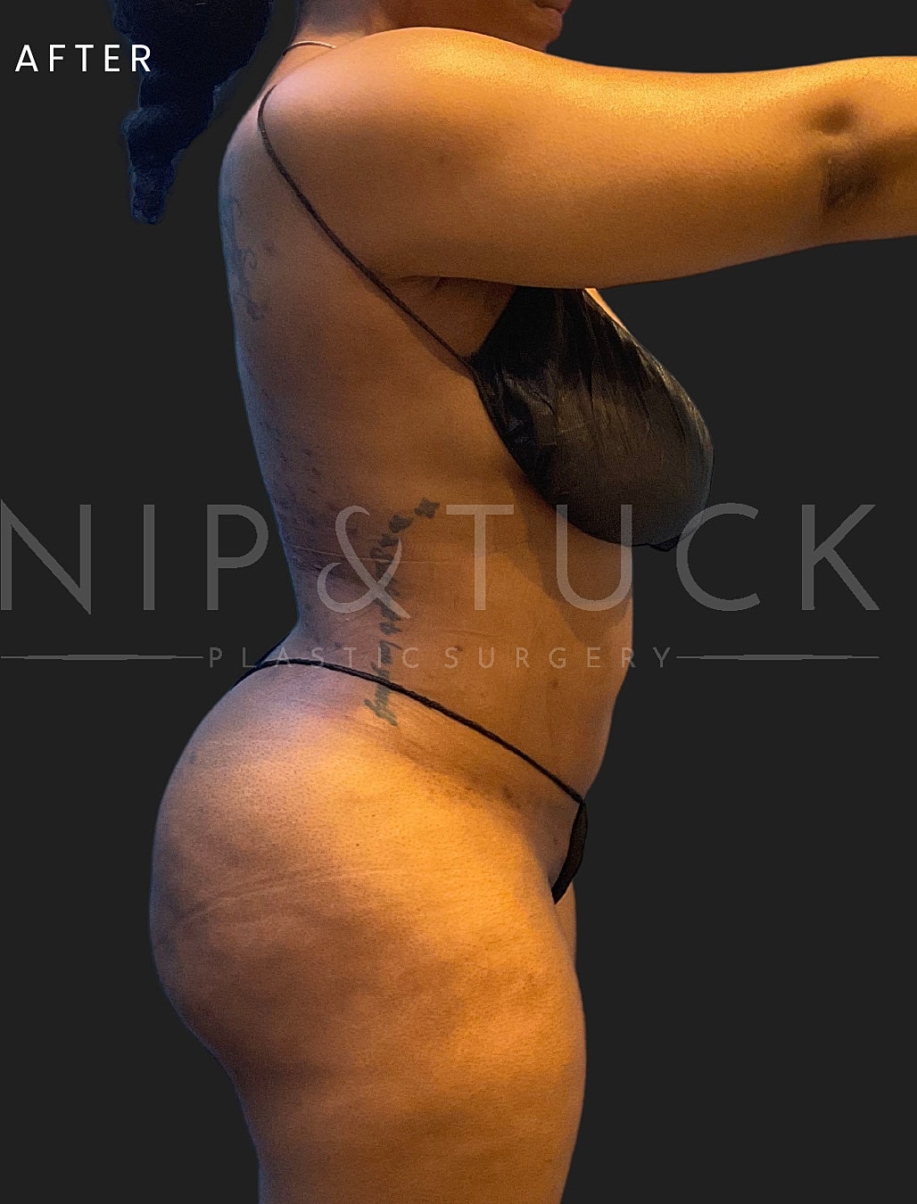 Vaser Liposuction Before & After