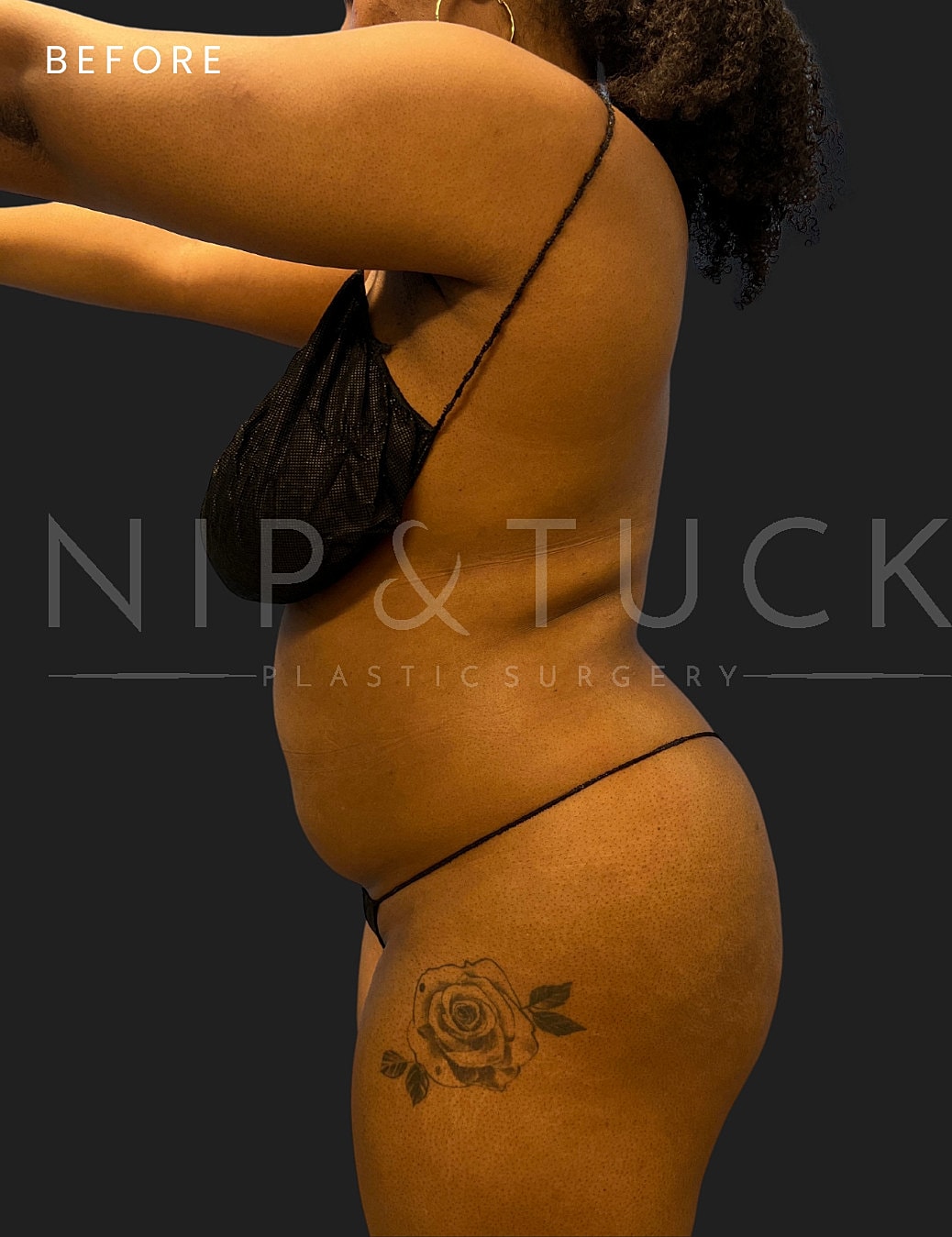 Vaser Liposuction Before & After