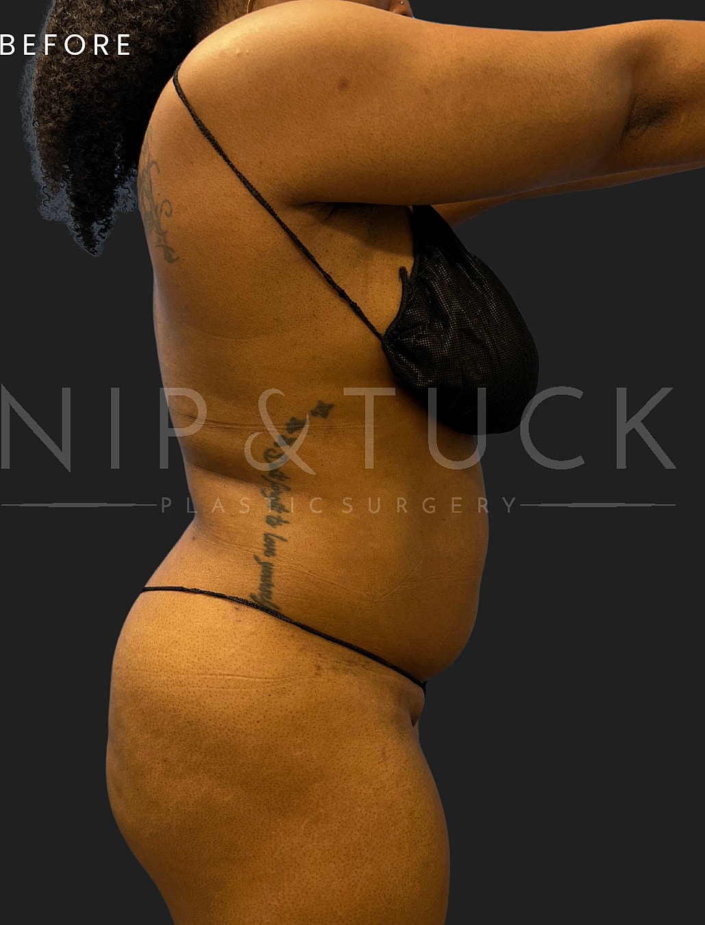 Vaser Liposuction Before & After