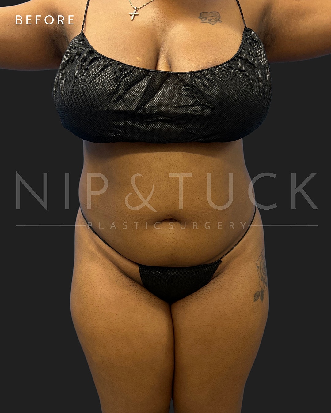Vaser Liposuction Before & After