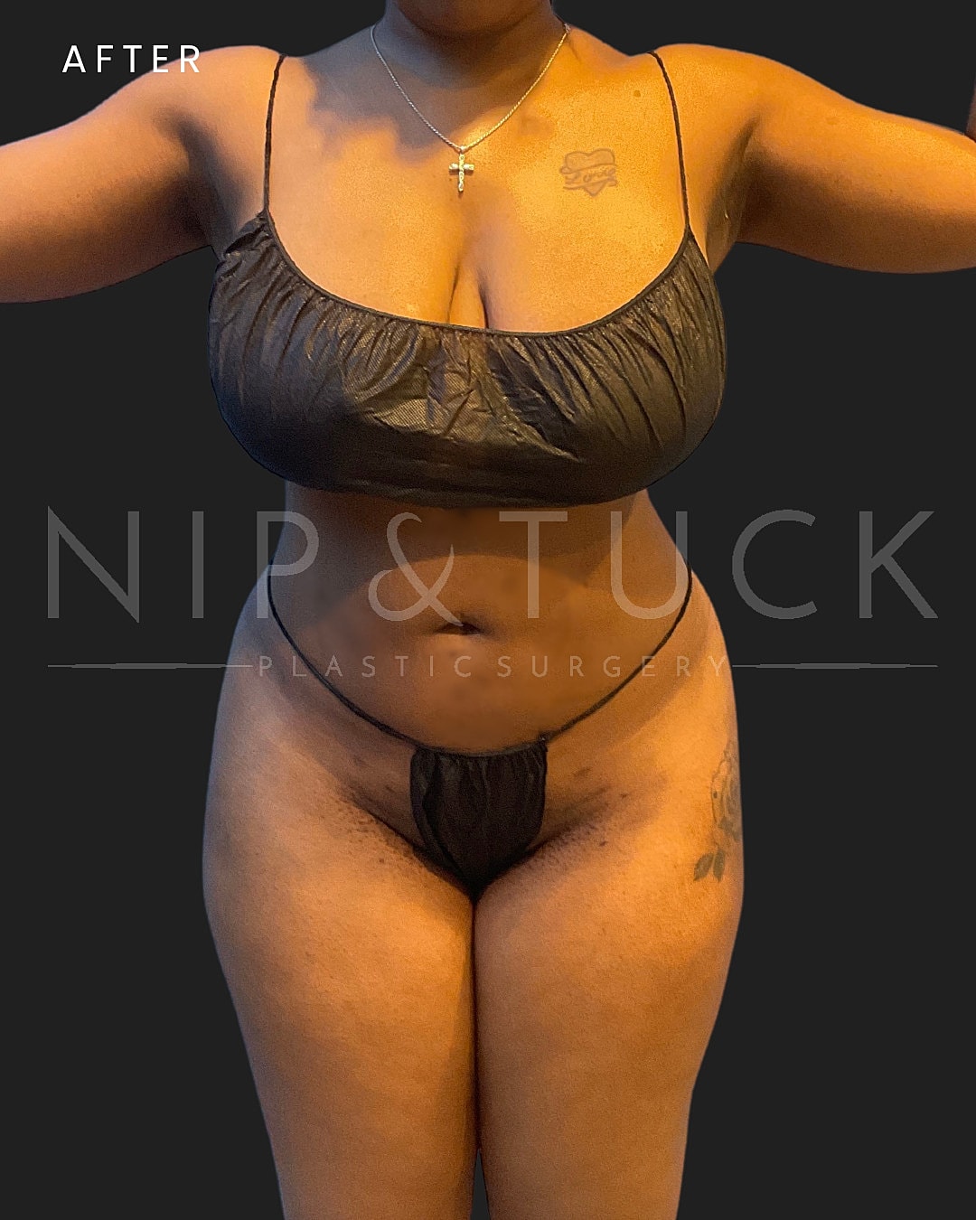 Vaser Liposuction Before & After