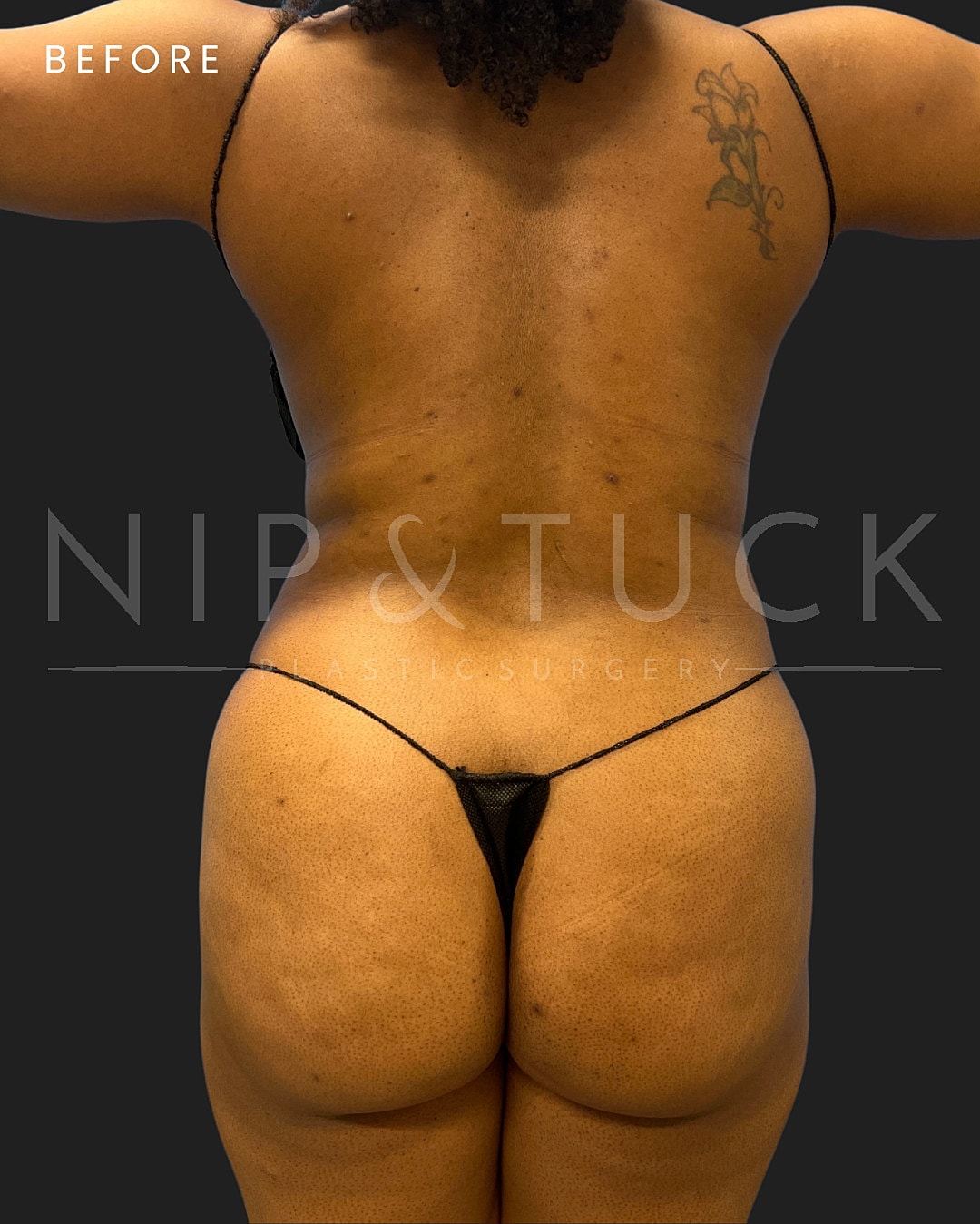 Vaser Liposuction Before & After