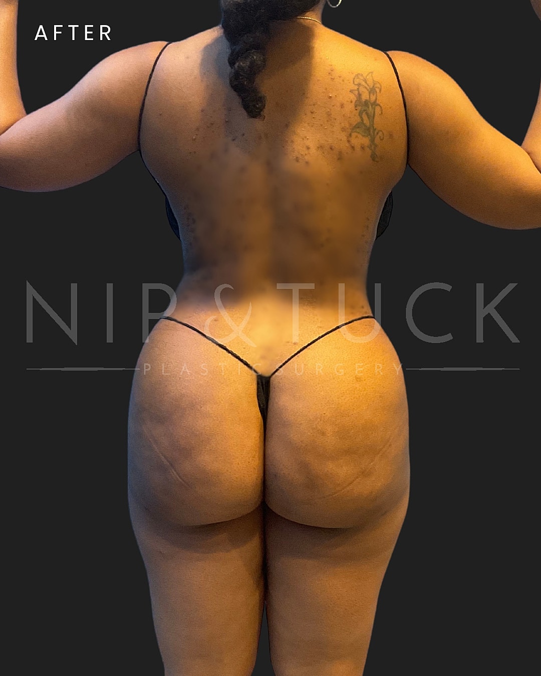 Vaser Liposuction Before & After