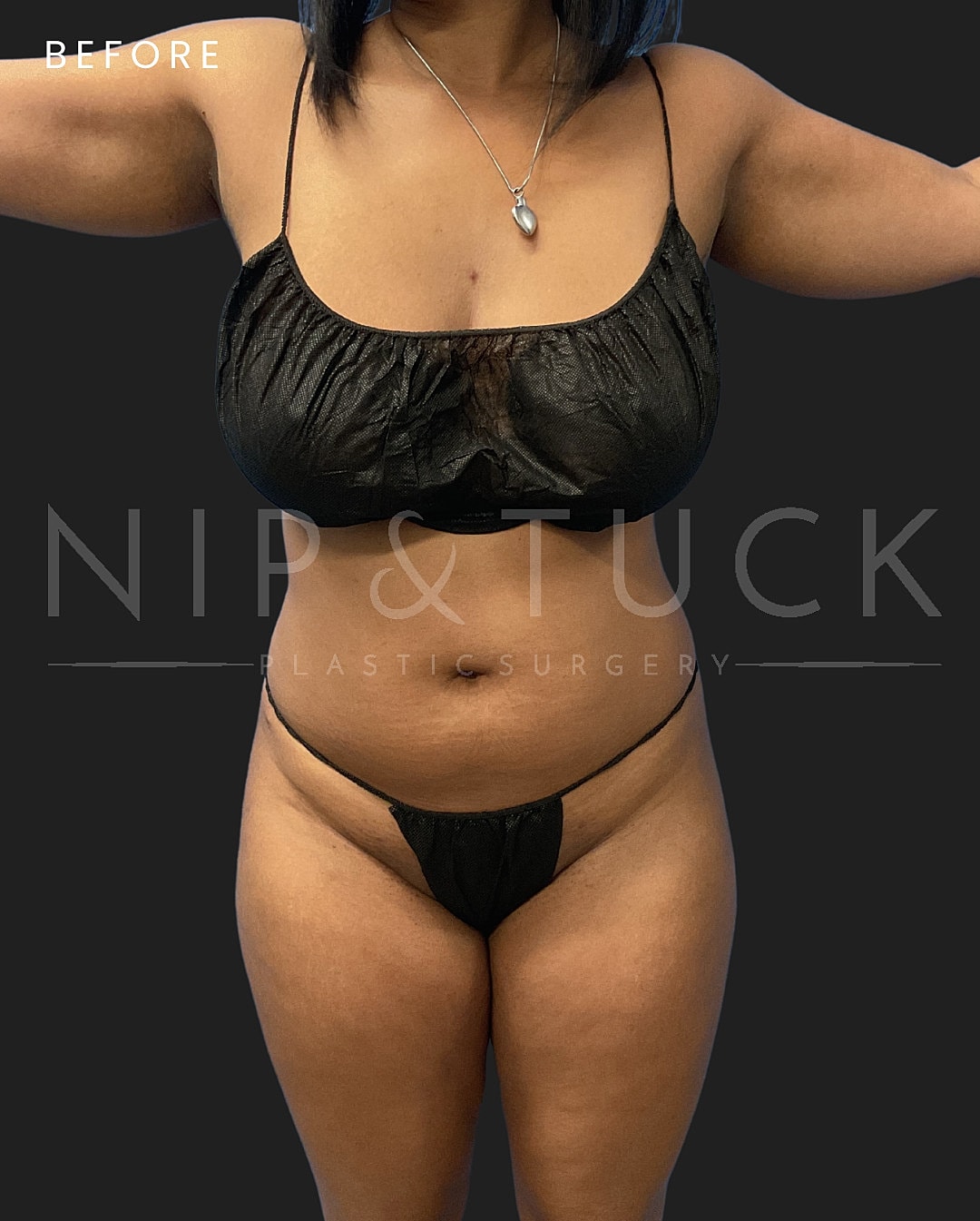 Vaser Liposuction Before & After